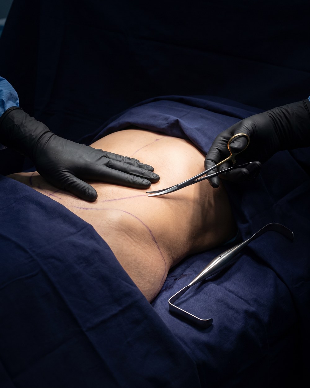 Mãos com luvas pretas junto à marcação do contorno do corpo antes de uma cirurgia plástica; o paciente está coberto pelo campo cirúrgico